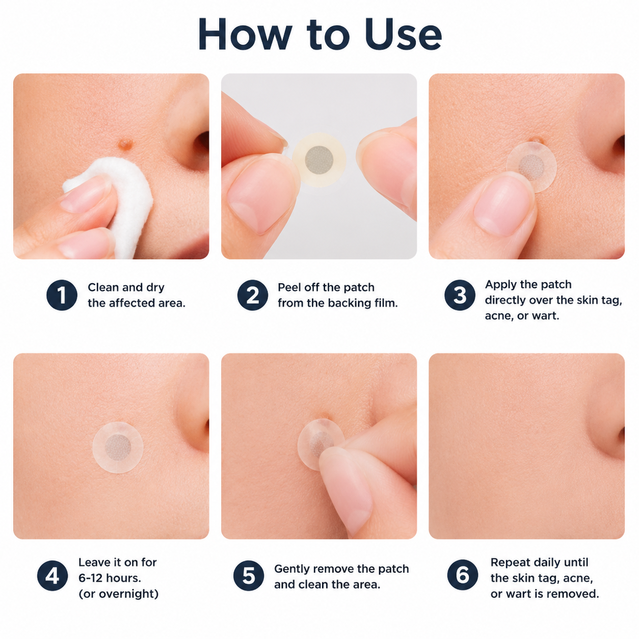 ✨Alcuras®2-in-1 Microneedle & Hydrocolloid Patch🍀| Removes Raised Moles, Acne, Flat Warts & Skin Tags | Helps Improve Wrinkles, Scars & Blemishes | Invisible Patches for Face & Body