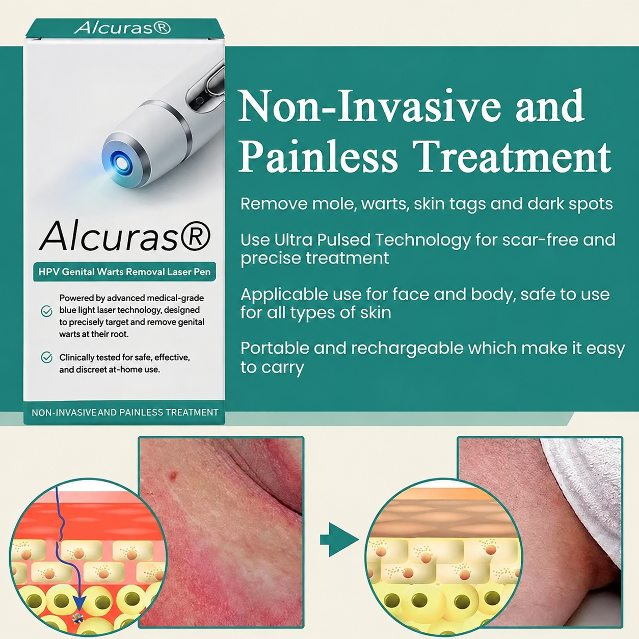 Alcuras® HPV Genital Warts Removal Laser Pen