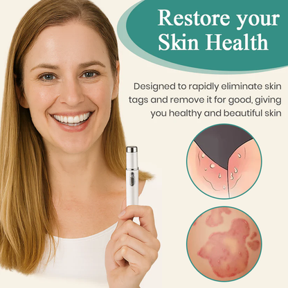 Alcuras® HPV Genital Warts Removal Laser Pen