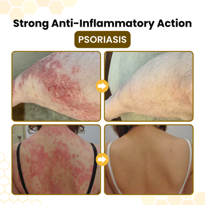 Alcuras® PsoriaSoothe Bee Venom Skin-Restoration Cream