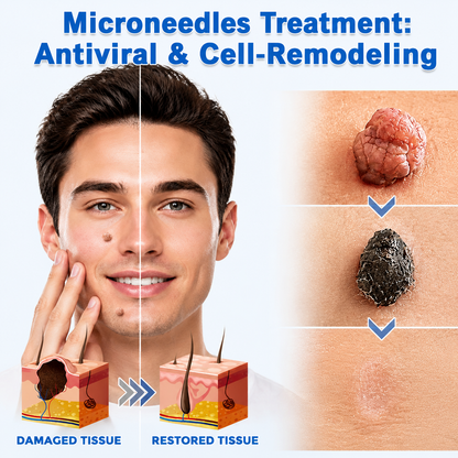 ✨Alcuras®2-in-1 Microneedle & Hydrocolloid Patch🍀| Removes Raised Moles, Acne, Flat Warts & Skin Tags | Helps Improve Wrinkles, Scars & Blemishes | Invisible Patches for Face & Body