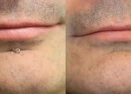 ✨Alcuras®2-in-1 Microneedle & Hydrocolloid Patch🍀| Removes Raised Moles, Acne, Flat Warts & Skin Tags | Helps Improve Wrinkles, Scars & Blemishes | Invisible Patches for Face & Body