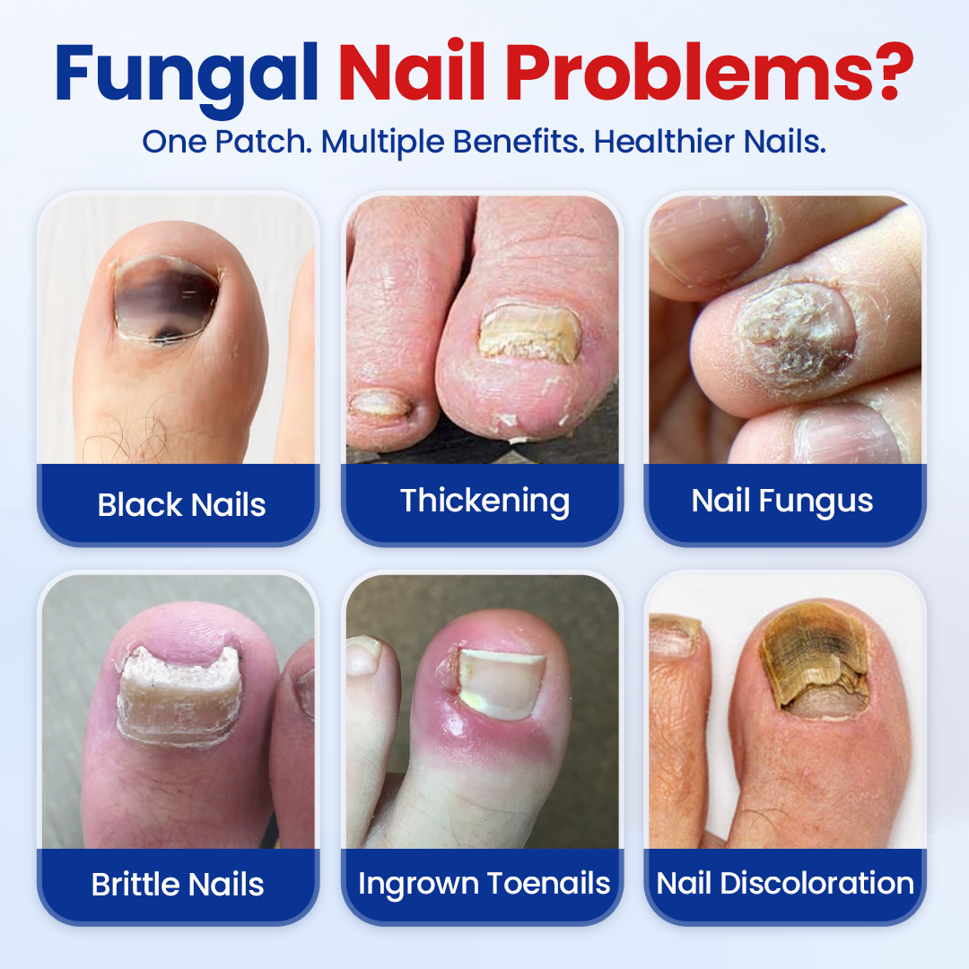 Alcuras® Fungal Nail Repair Patches