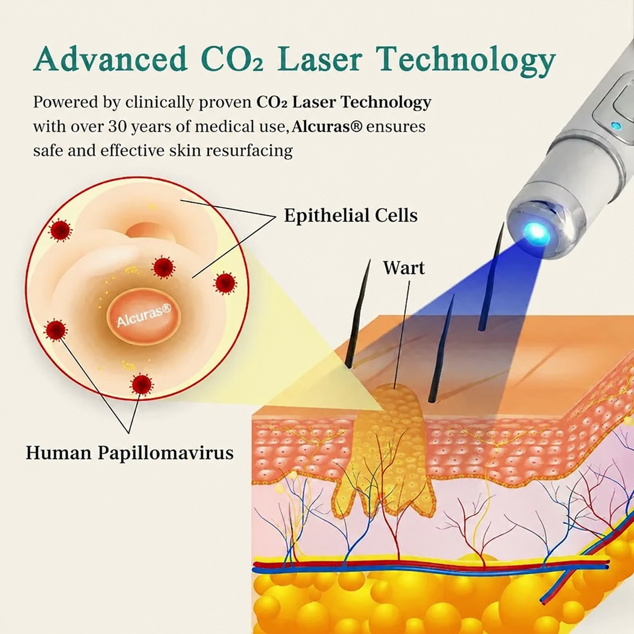 Alcuras® HPV Genital Warts Removal Laser Pen