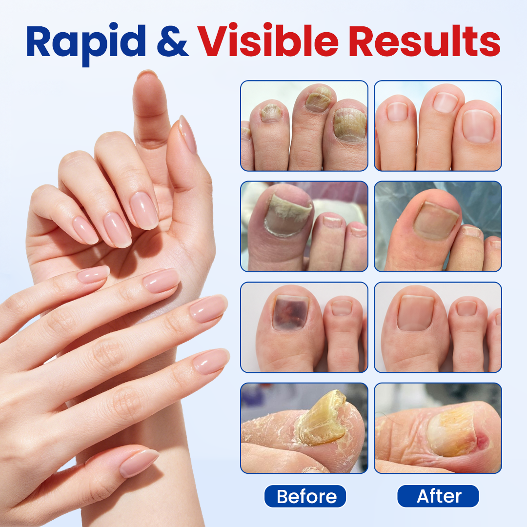 Alcuras® Fungal Nail Repair Patches