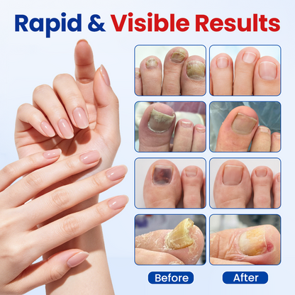 Alcuras® Fungal Nail Repair Patches