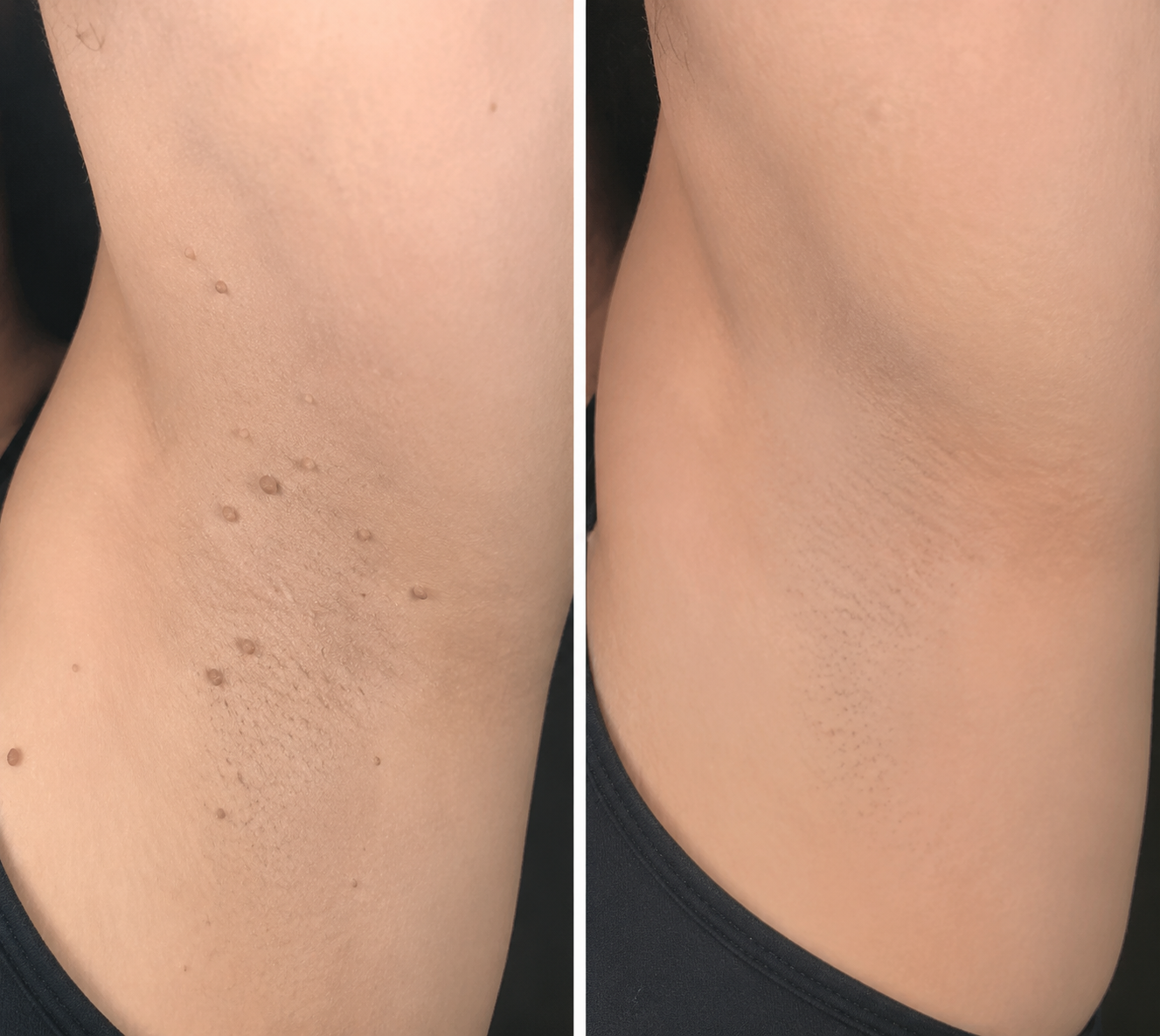 ✨Alcuras®2-in-1 Microneedle & Hydrocolloid Patch🍀| Removes Raised Moles, Acne, Flat Warts & Skin Tags | Helps Improve Wrinkles, Scars & Blemishes | Invisible Patches for Face & Body