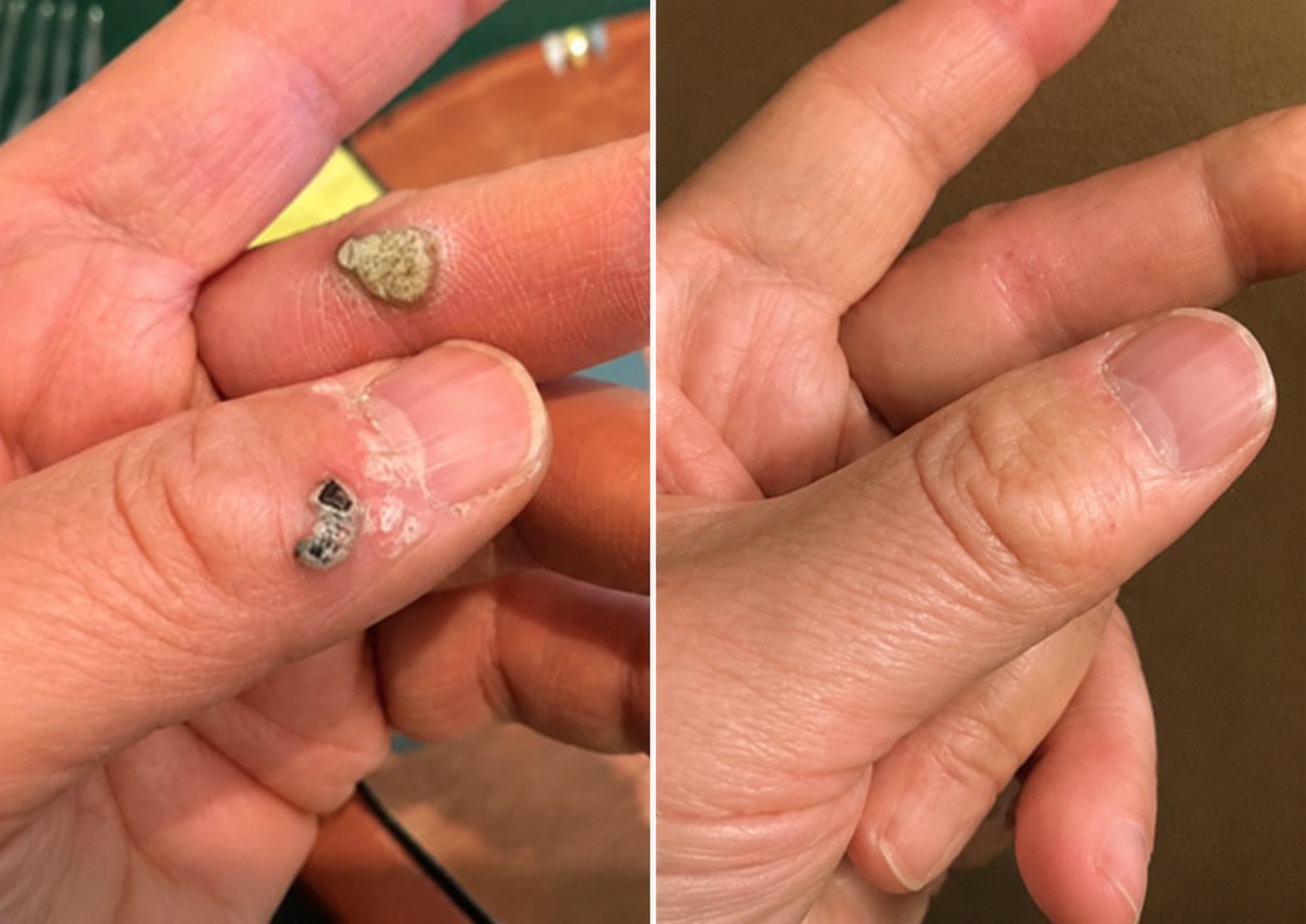 ✨Alcuras®2-in-1 Microneedle & Hydrocolloid Patch🍀| Removes Raised Moles, Acne, Flat Warts & Skin Tags | Helps Improve Wrinkles, Scars & Blemishes | Invisible Patches for Face & Body