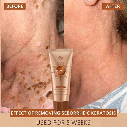 Alcuras™ Whitening and Spot-Removing Face Mask Suitable for face and body – 👩‍⚕️ Natural ingredients permanently remove age spots, freckles, sun spots, and liver spots.