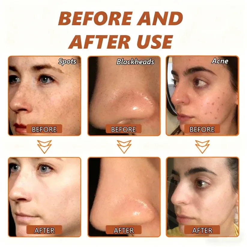 Alcuras™ Whitening and Spot-Removing Face Mask Suitable for face and body – 👩‍⚕️ Natural ingredients permanently remove age spots, freckles, sun spots, and liver spots.