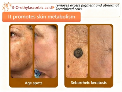 Alcuras™ Whitening and Spot-Removing Face Mask Suitable for face and body – 👩‍⚕️ Natural ingredients permanently remove age spots, freckles, sun spots, and liver spots.
