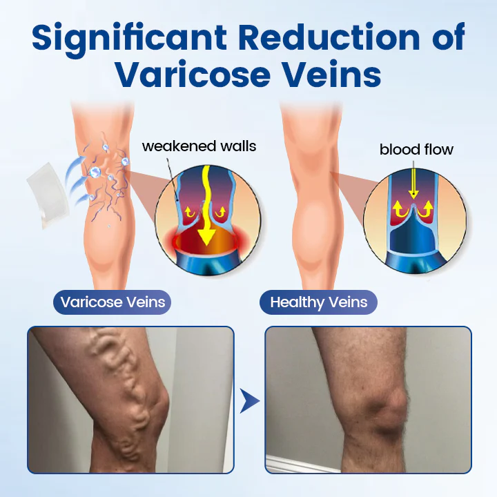 Alcuras™ Vein Ease Microneedle Therapy Patch - Fast ⚡Effective 💪 and Non-Invasive 🚫 Treatment for Varicose Veins & Leg Swelling 👣