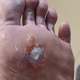 Alcuras®️ The Promise: Sandal Confidence Again—Without Shame, Without Pain, Without Recurrence
