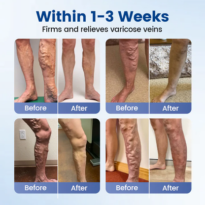 Alcuras™ Vein Ease Microneedle Therapy Patch - Fast ⚡Effective 💪 and Non-Invasive 🚫 Treatment for Varicose Veins & Leg Swelling 👣