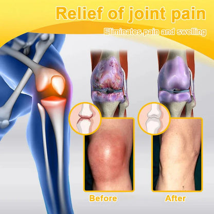 🔥Alcuras™ Botulinum Toxin & Bee Venom Pain-Relief Bone Healing Cream🐝💎