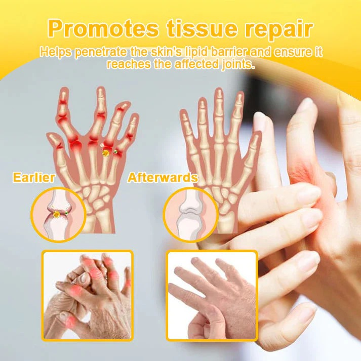 🔥Alcuras™ Botulinum Toxin & Bee Venom Pain-Relief Bone Healing Cream🐝💎
