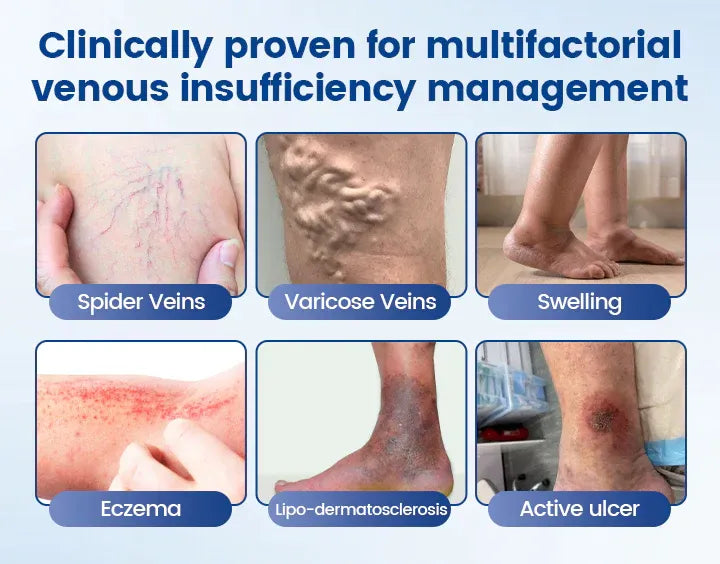 Alcuras™ Vein Ease Microneedle Therapy Patch - Fast ⚡Effective 💪 and Non-Invasive 🚫 Treatment for Varicose Veins & Leg Swelling 👣