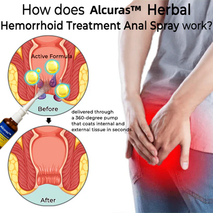 Alcuras™ Herbal Hemorrhoid Treatment Anal Spray Pro