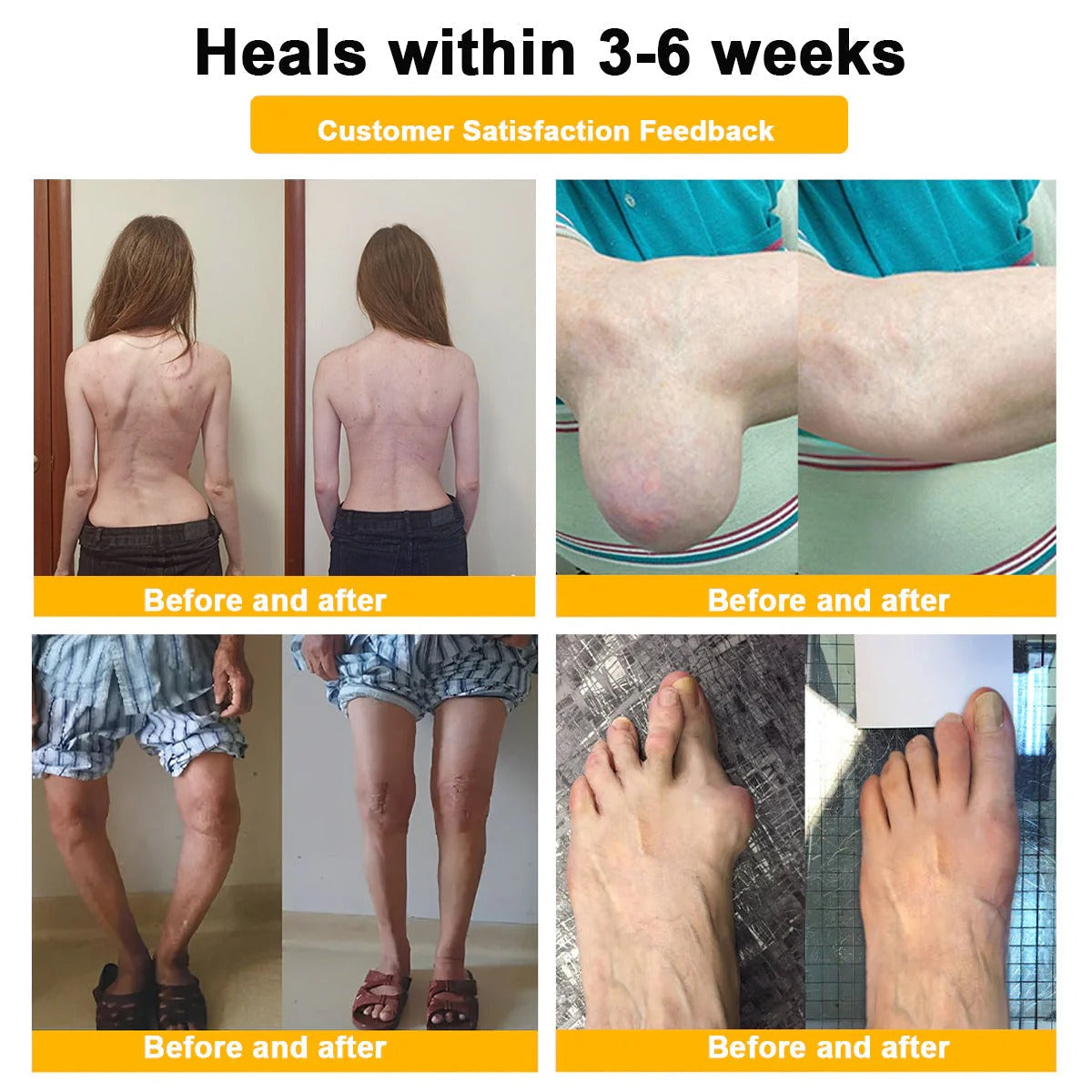 🔥Alcuras™ Botulinum Toxin & Bee Venom Pain-Relief Bone Healing Cream🐝💎