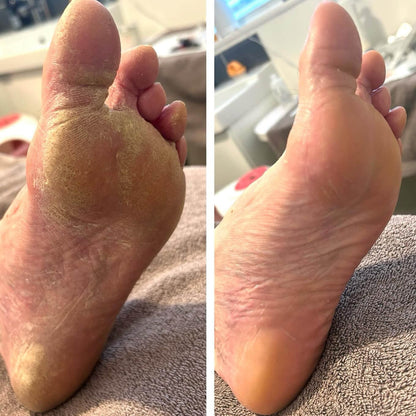 Alcuras®️ The Promise: Sandal Confidence Again—Without Shame, Without Pain, Without Recurrence