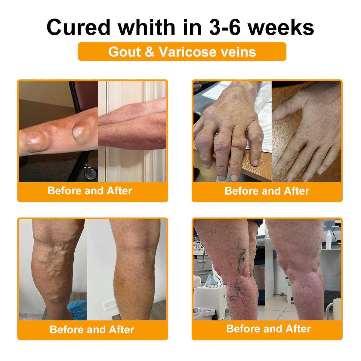 🔥Alcuras™ Botulinum Toxin & Bee Venom Pain-Relief Bone Healing Cream🐝💎