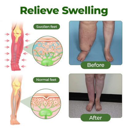 Alcuras™ Edema Relief Lotion