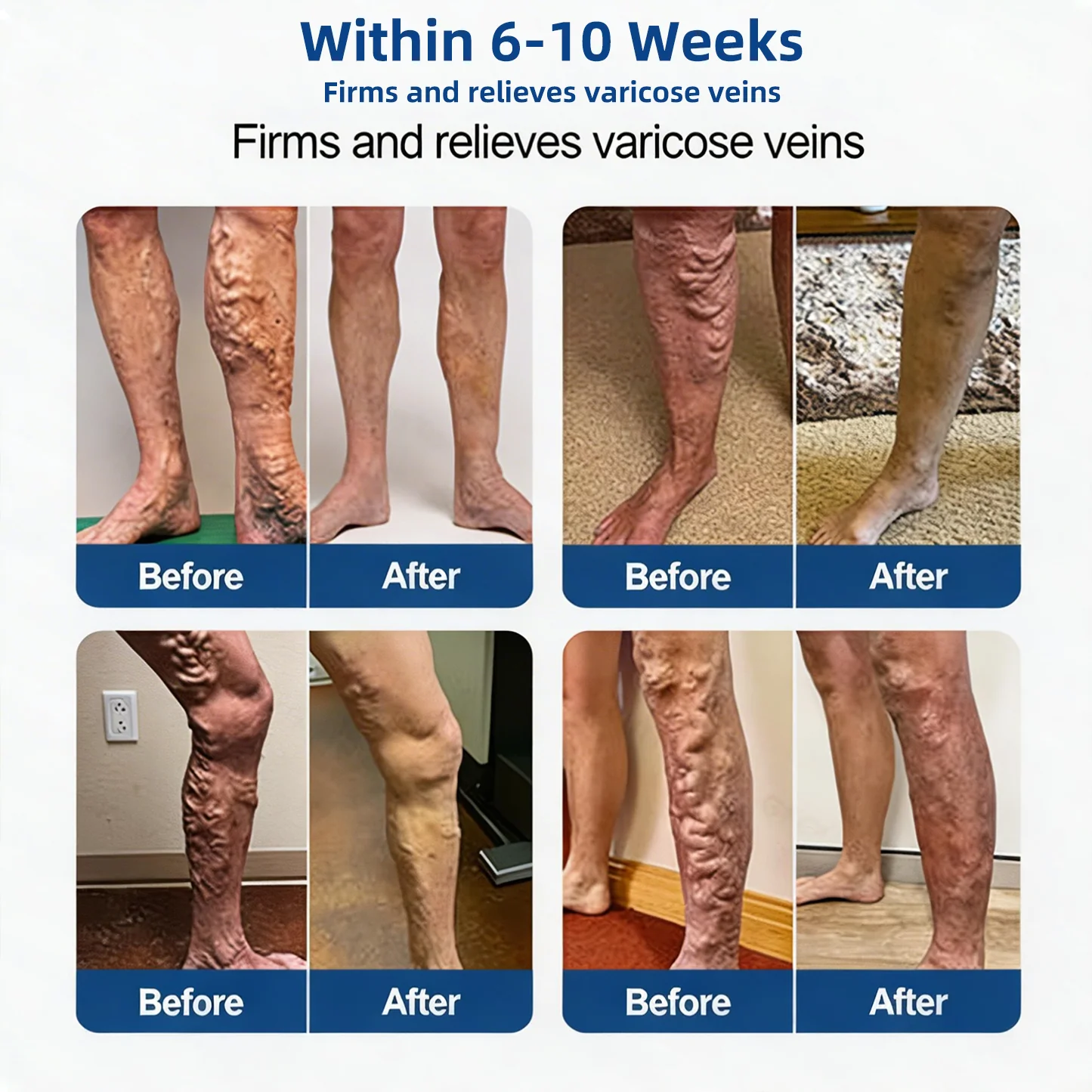 Alcuras® Vein Contour Microneedle Patch – 7-Day Visible Results for Varicose Veins