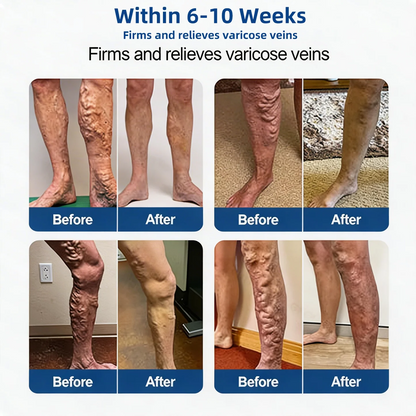 Alcuras® Vein Contour Microneedle Patch – 7-Day Visible Results for Varicose Veins