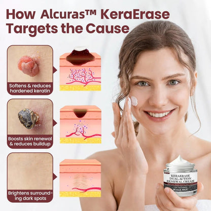 Alcuras™ KeraErase Dual-Action Renewal Cream